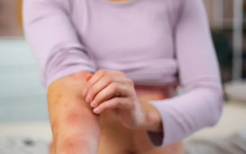 &Uuml;lkede kızamık vaka sayısı 165'e ulaştı 